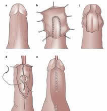 urethroplasty-surgery-India